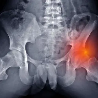 sindrome femoroacetabular